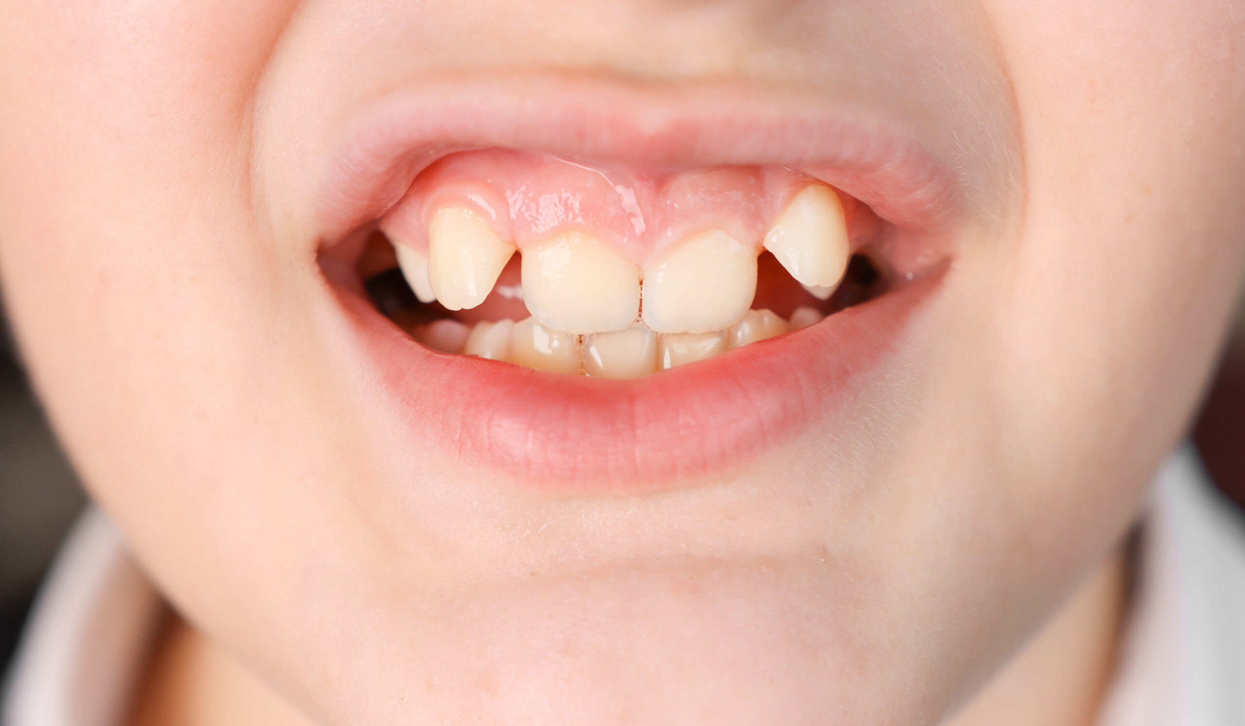 Close-up of a child's mouth with malpositioned teeth.